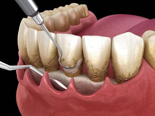 Dental Implants